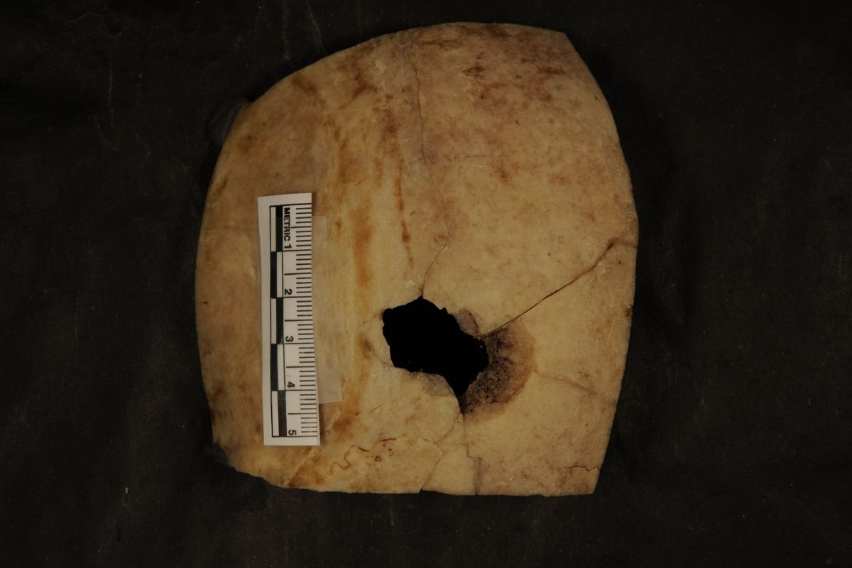 Lésion balistique dans le crâne